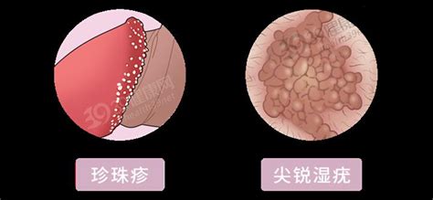 龜頭下緣